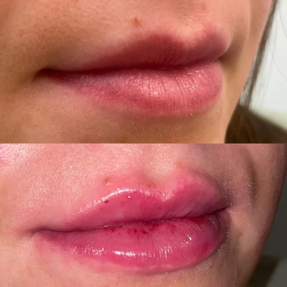Lip Augmentation before-and-after result, patient case 02