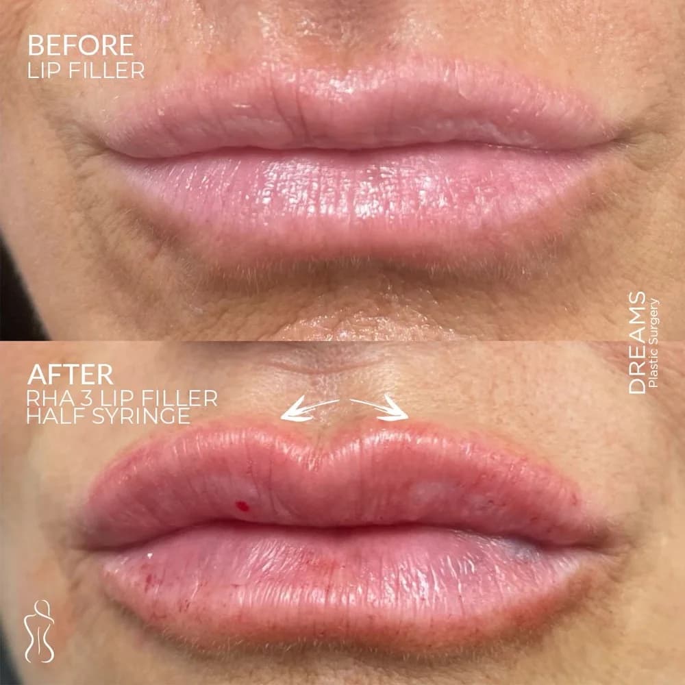 Lip Augmentation before-and-after result, patient case 03