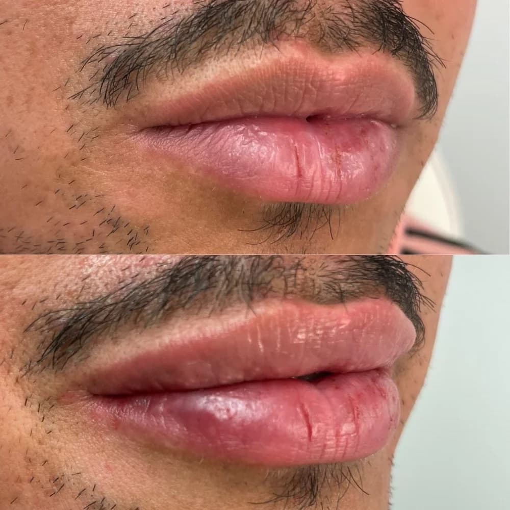 Lip Augmentation before-and-after result, patient case 04