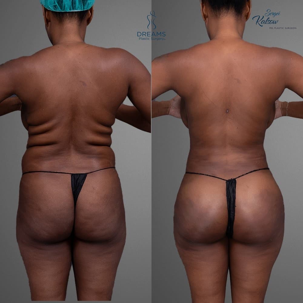 Lipo 360 and BBL before-and-after result, patient case 01