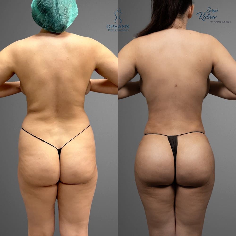 Lipo 360 and BBL before-and-after result, patient case 02
