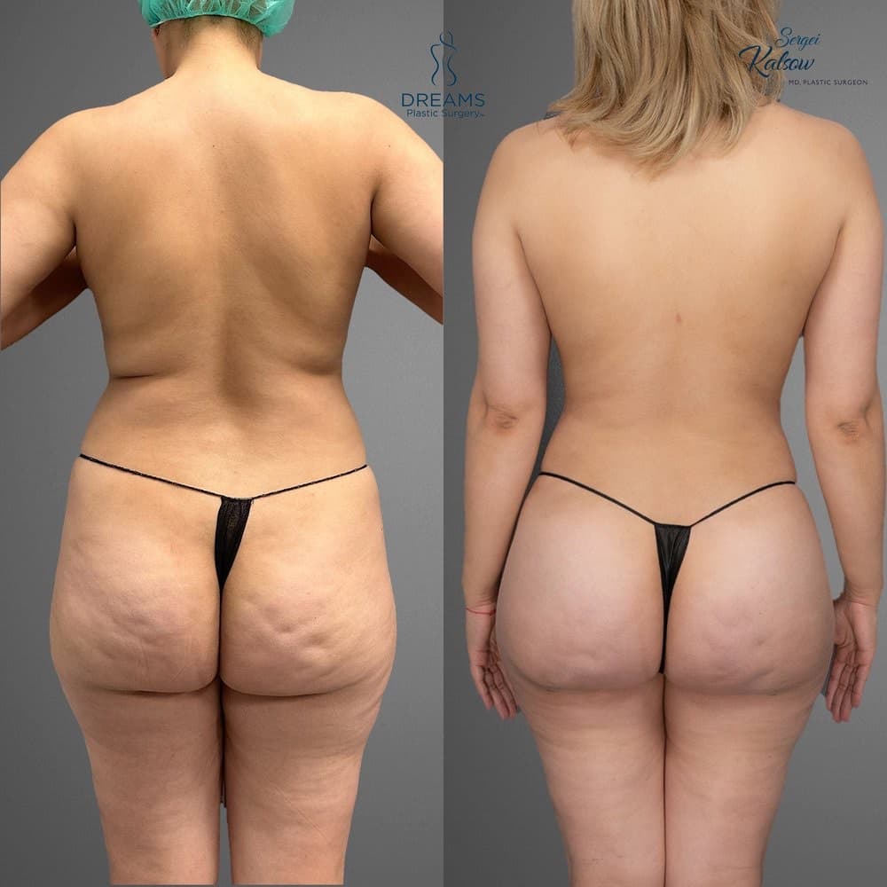 Lipo 360 and BBL before-and-after result, patient case 03
