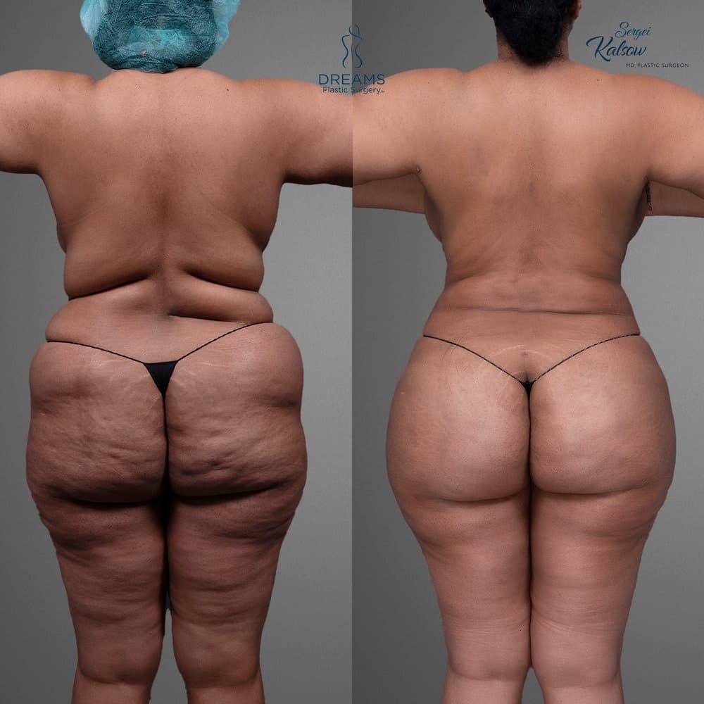 Lipo 360 and BBL before-and-after result, patient case 04
