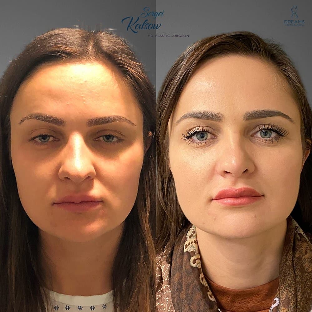 Rhinoplasty before-and-after result, patient case 01