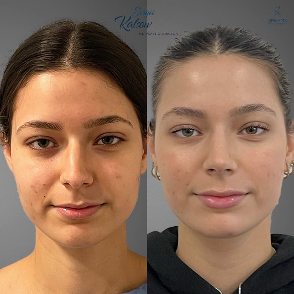 Rhinoplasty before-and-after result, patient case 03
