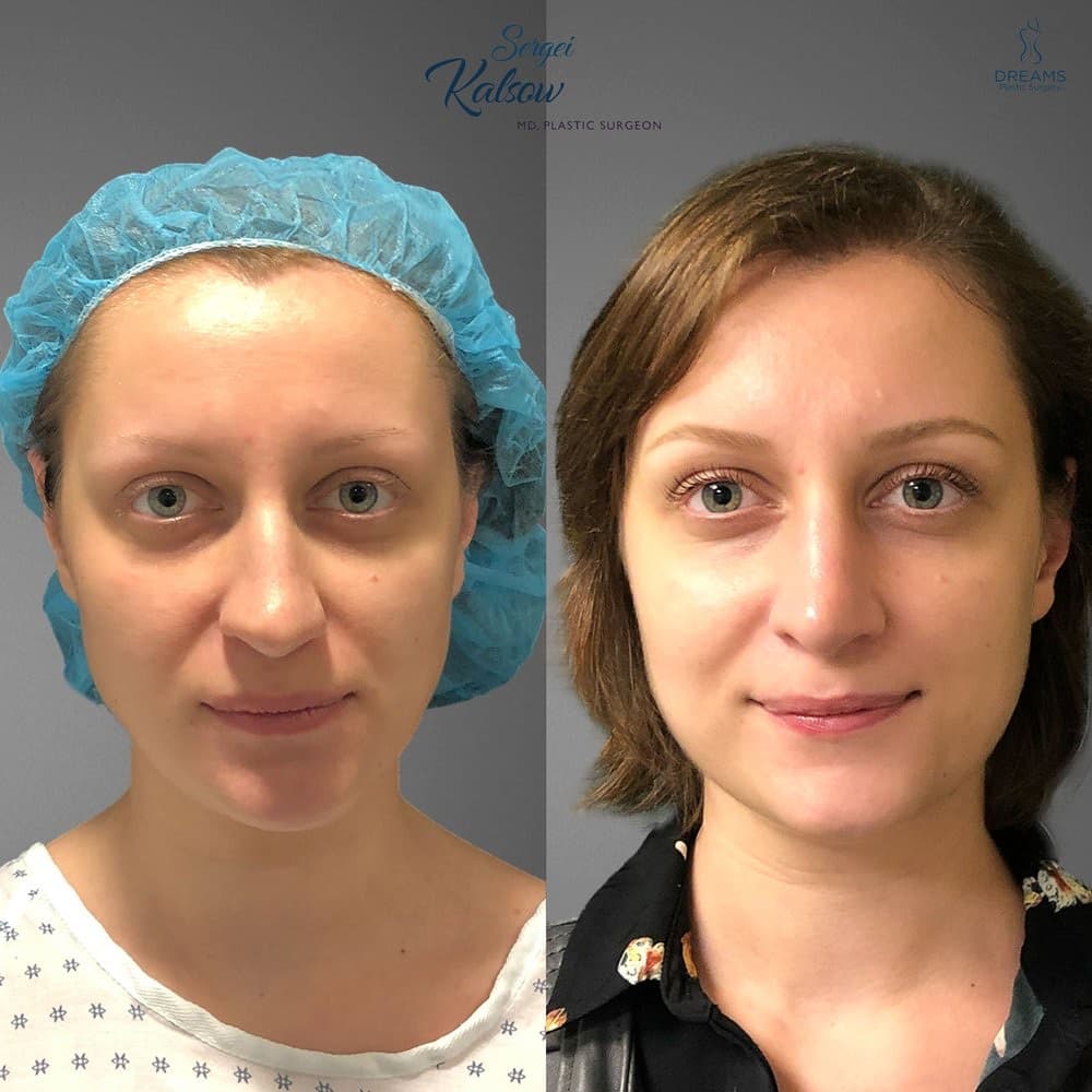 Rhinoplasty before-and-after result, patient case 04