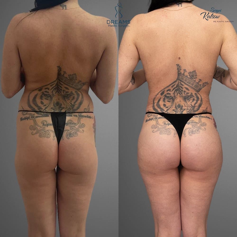 Skinny BBL before-and-after result, patient case 02