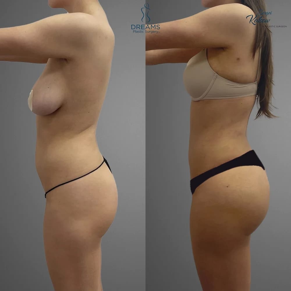 Skinny BBL before-and-after result, patient case 03