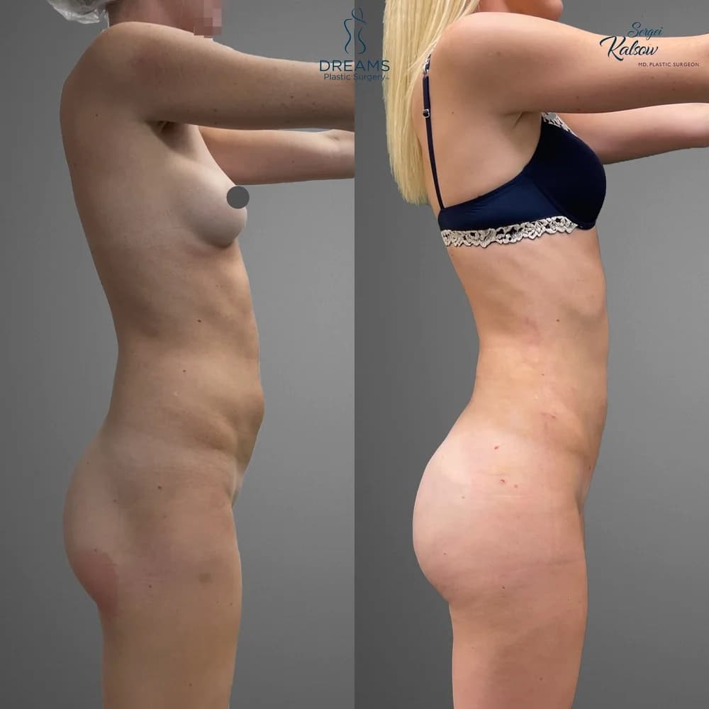 Skinny BBL before-and-after result, patient case 04