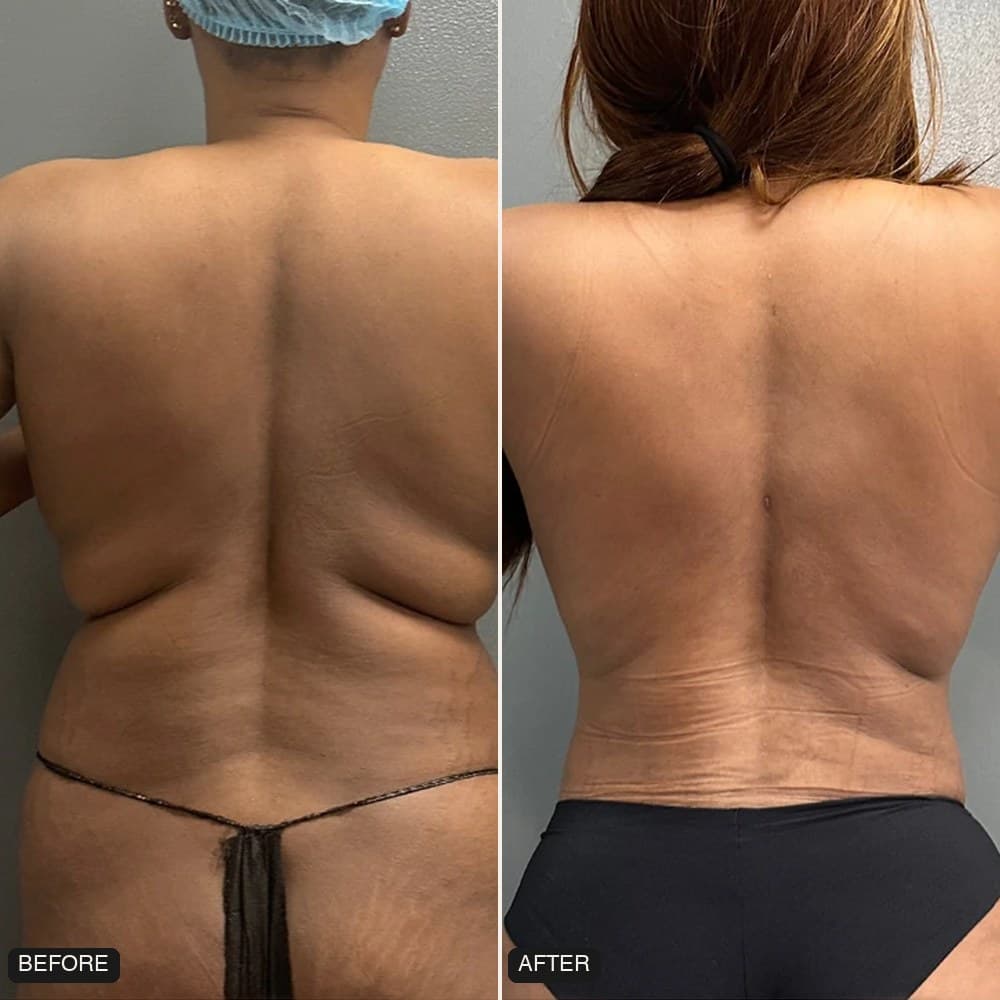 Awake Lipo 360 before and after, back view, patient case 01