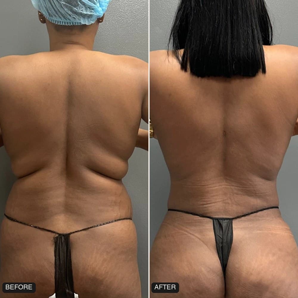Awake Lipo 360 before and after, back view, patient case 02